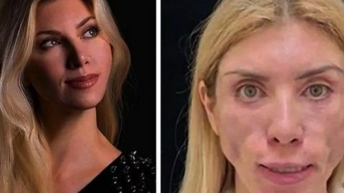 Russia, dopo la chirurgia estetica non riesce più a chiudere gli occhi e a sorridere