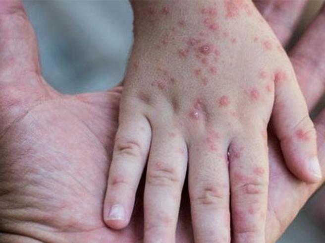 Vaiolo delle scimmie, OMS registra un rallentamento dei nuovi casi