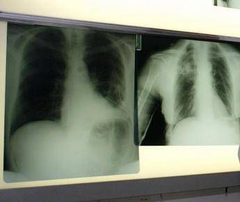 Salute, esperti: “Virus sinciziale sottovalutato nonostante oltre 50mila ricoveri l’anno”