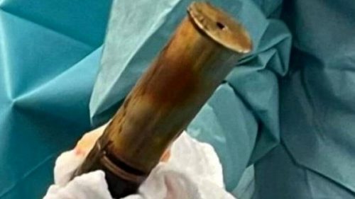 Francia, “Dottore, ho una bomba nel retto”: evacuato l’ospedale