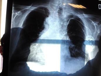 Bpco, pneumologa Foschino Barbaro: “Nella donna sintomi diversi, attenzione alle giovani”