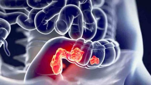 L’aspirina accende le difese contro il cancro del colon retto: l’uso regolare aiuta la risposta del sistema immunitario