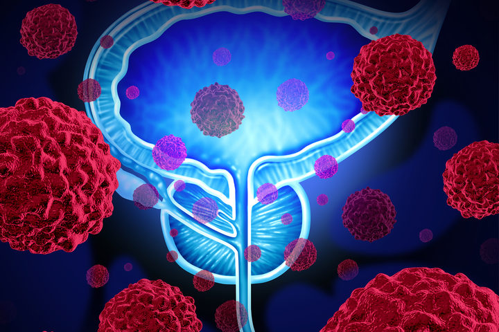Tumore alla prostata, nel 2022 40.500 diagnosi: +16%