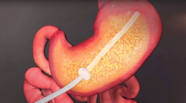 Prima gastroscopia senza tubo a Roma al Policlinico “Gemelli” con video-capsula capace di esplorare le pareti dello stomaco