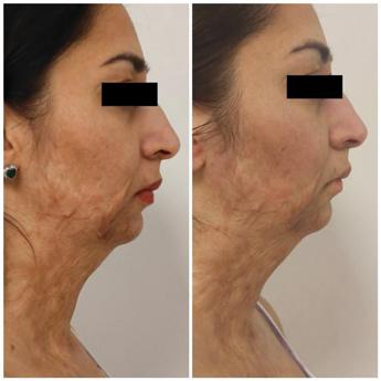 La storia di Pinky, bruciata dal marito e oggi rinata grazie al progetto RigeneraDerma