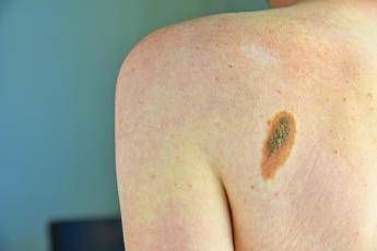Melanoma, Ascierto (Scito): “Con immunoterapia più speranze per metà forme gravi”
