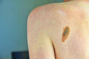 Ok Aifa a immunoterapia in fase precoce per melanoma e carcinoma polmonare