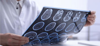 Sclerosi multipla per 144mila italiani, 10% è fuori da percorsi cura e assistenza