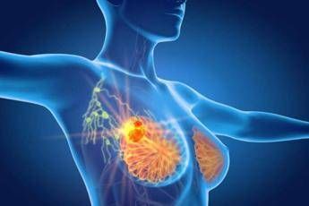 Tumore al seno triplo negativo, speranze da anticorpo farmaco-coniugato