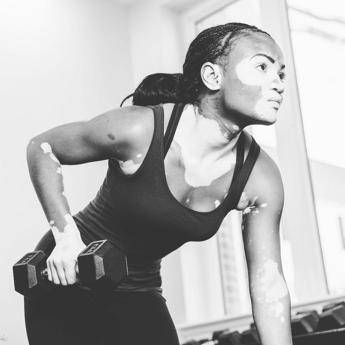 E’ la Vitiligine week, “così la terapia della luce aiuta il farmaco”