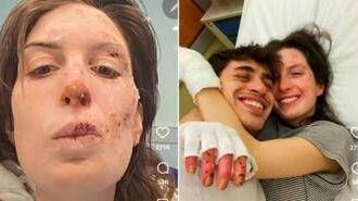 Crans-Montana, oggi dimessi due ragazzi. Eleonora Palmieri mostra le ustioni sui social