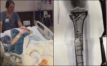 Milano Cortina, Vonn mostra la gamba dopo le operazioni: “Dolore difficile da gestire”