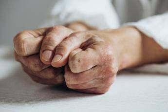 Open day psoriasi, l’11 marzo visite gratis in 90 ospedali Bollino rosa