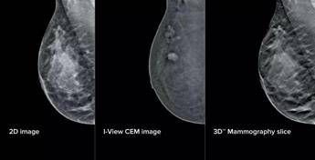 Mammografia ‘intelligente’ al San Camillo di Roma, aiuterà gli specialisti nelle diagnosi