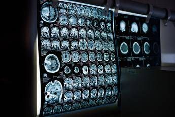 Uno spray nasale ferma l’invecchiamento del cervello, lo studio