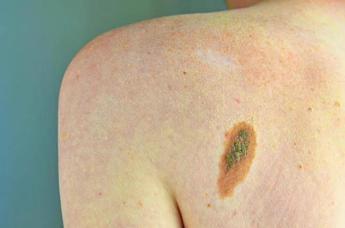 Imi: “Bene legge su prevenzione melanoma, educare i giovani su rischi”