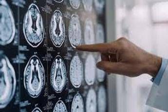 Salute, 300mila persone in Italia con Parkinson, 10% ha diagnosi prima dei 50 anni