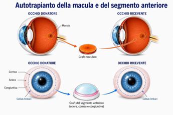 Torna a vedere dopo trapianto di retina da un occhio all’altro, è la prima volta al mondo