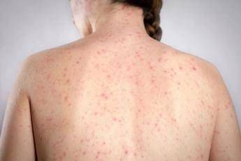 Morbillo, l’allarme dell’infettivologo Andreoni: “Casi in crescita, ricoveri frequenti negli adulti”